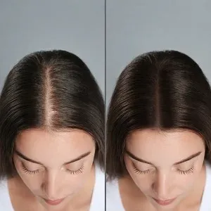 Hair Restoration Treatment Results